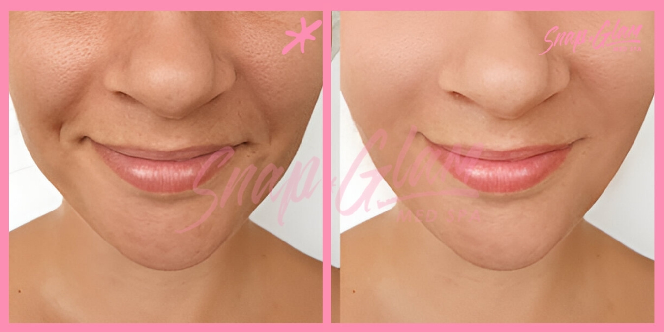 Dermal Fillers-1 (2)