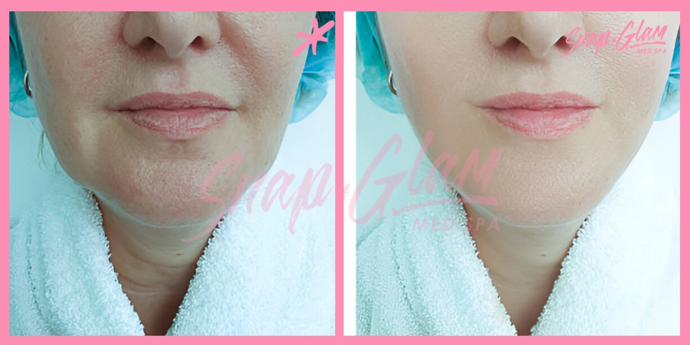 Dermal Fillers-1 (3)