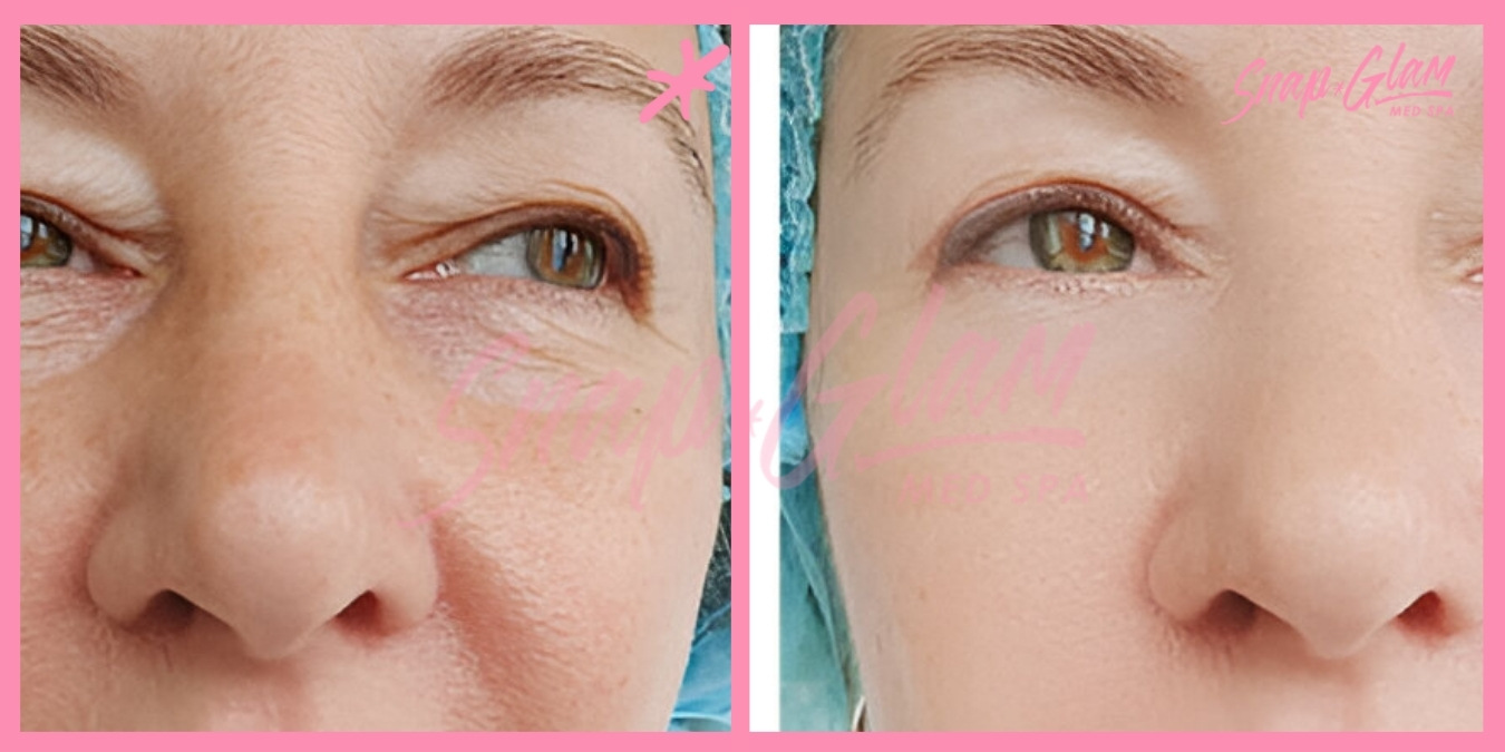 Dermal Fillers-1 (4)