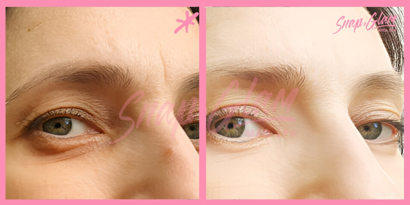 Dermal Fillers-1 (5)