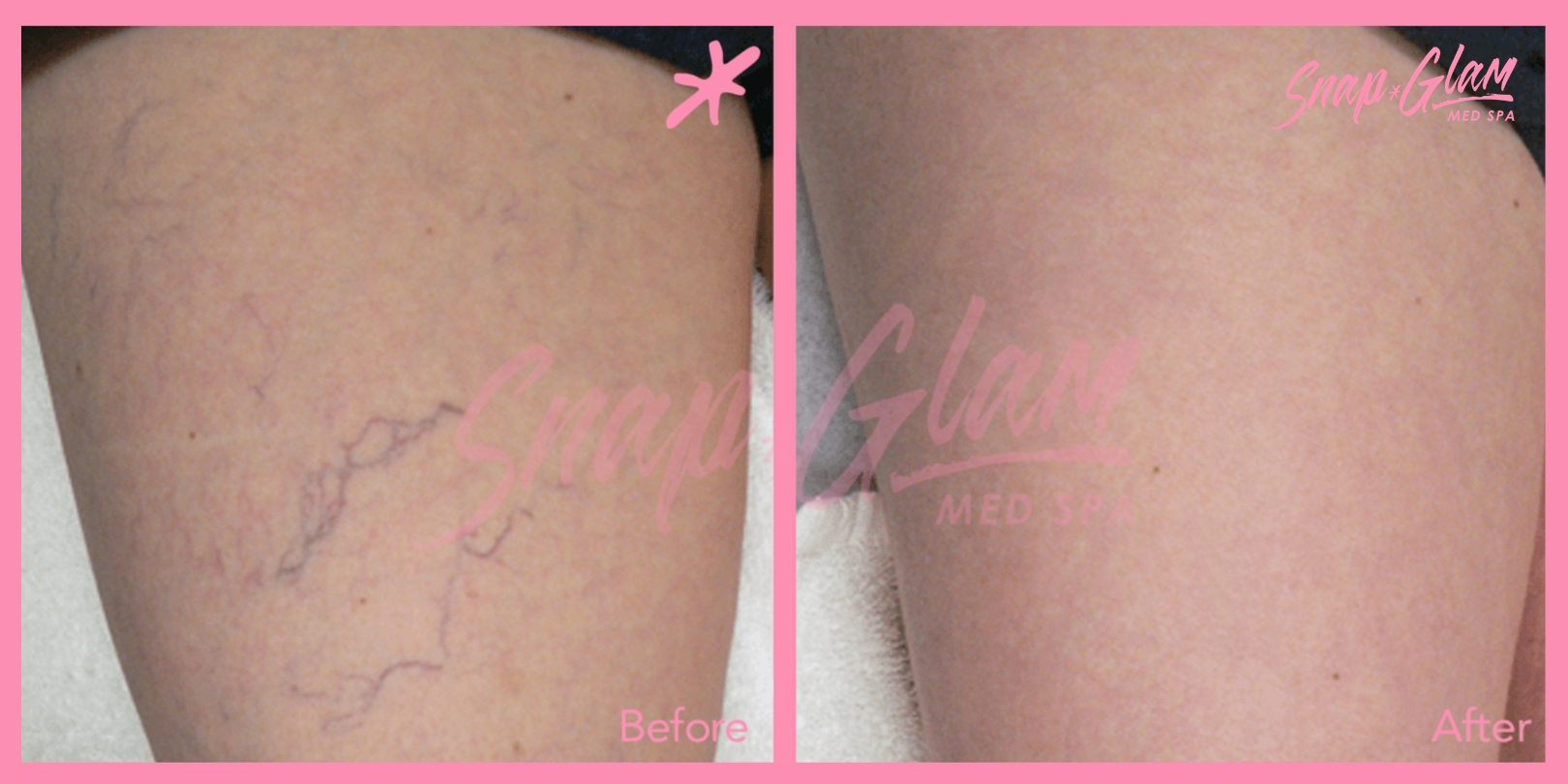 Hip injections Before afters (4)