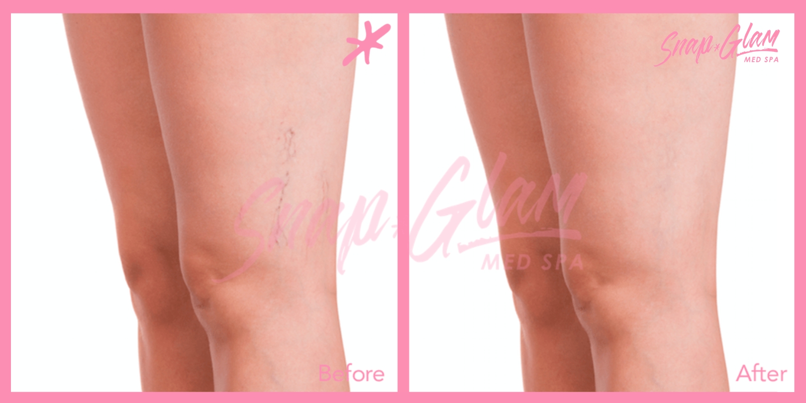 Hip injections Before afters (5)