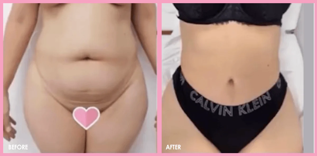 Tummy Tuck