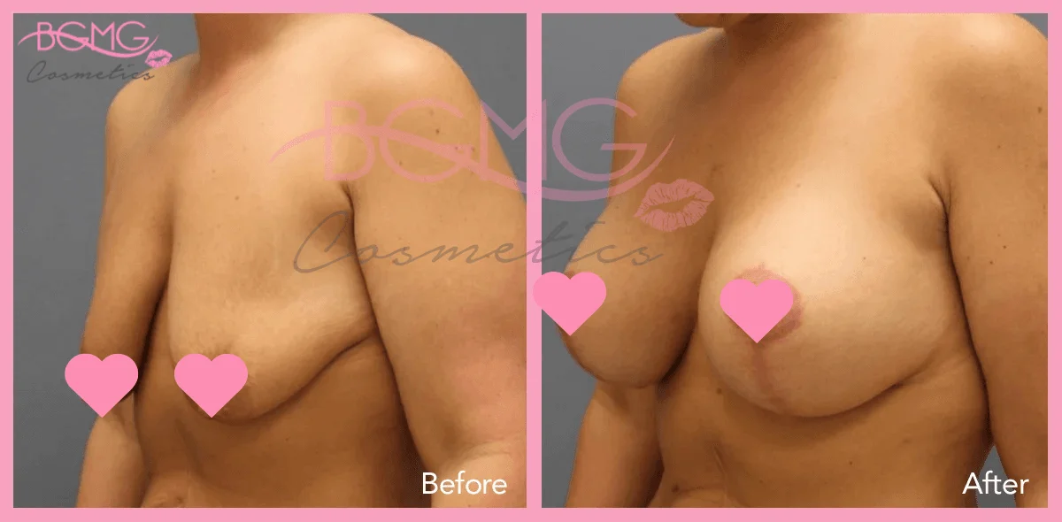 breast lift before after 2