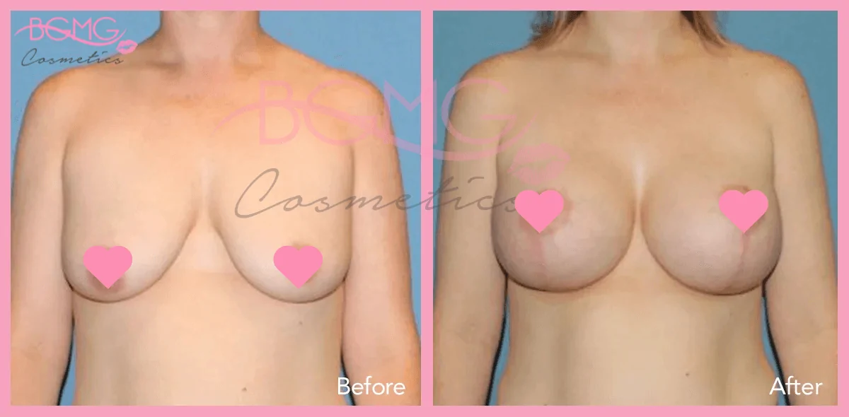 breast lift before after 2