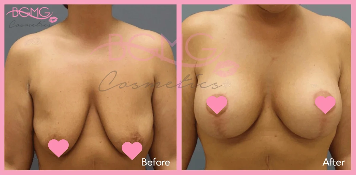 breast lift before after 1