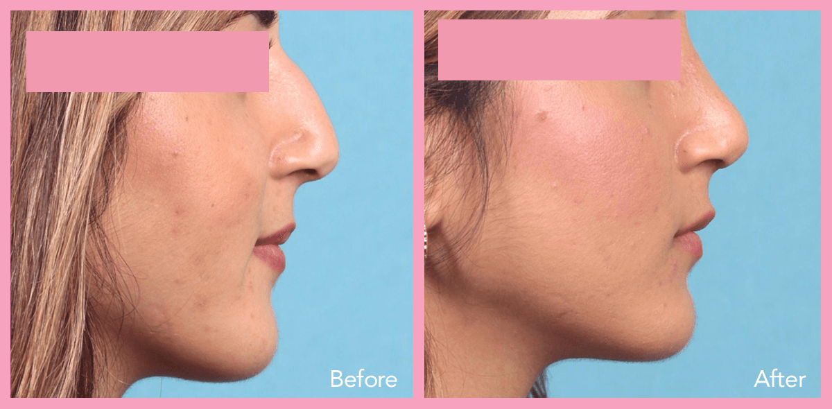 62912a1e5967330f6240aa95_nose-surgery-1