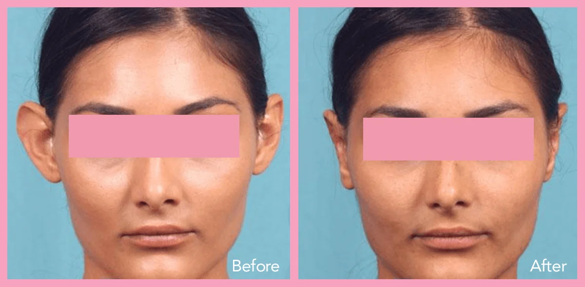 62912a1e5967333ee440ab13_ear-surgery-2