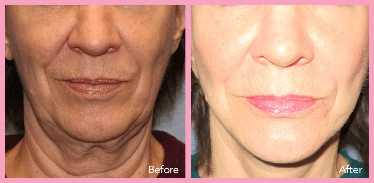 62912a1e596733440840aaea_neck-lift-1