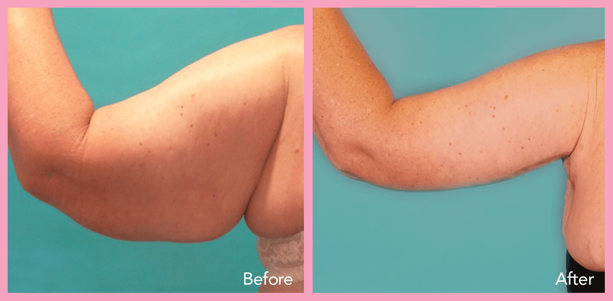 62912a1e5967335a9440ab22_arm-lift-3