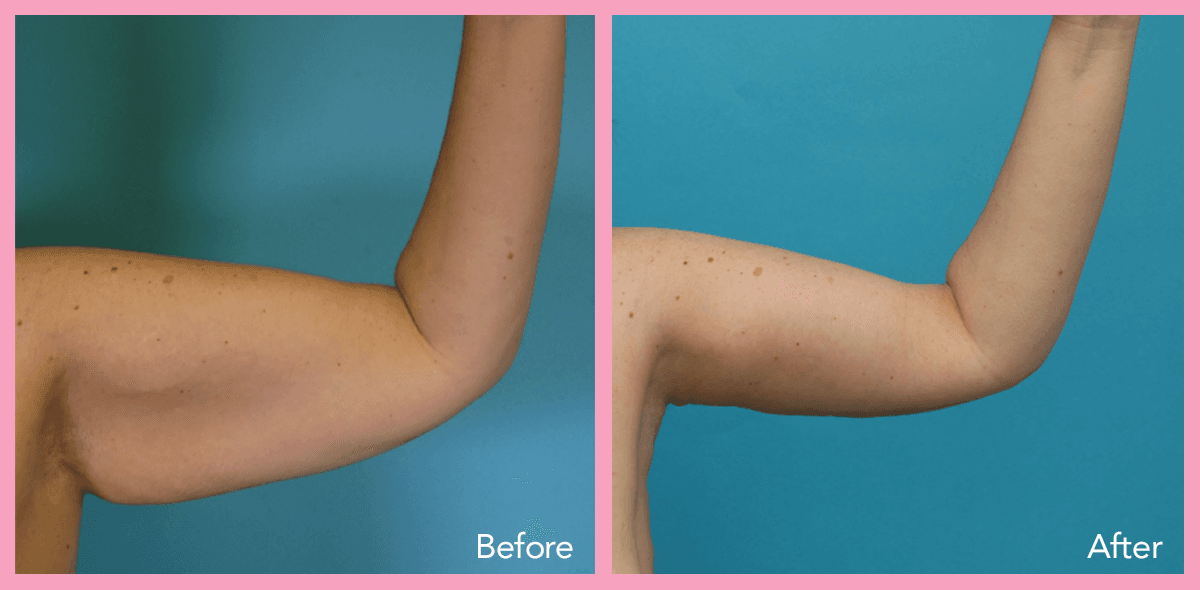 62912a1e5967335d3540ab1a_arm-lift-4