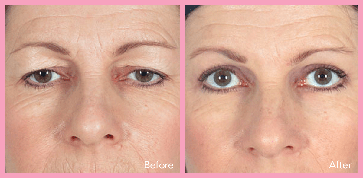 real eyelid surgery before & after results from our happy patients