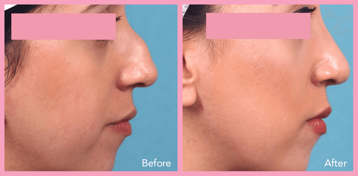 62912a1e59673368aa40aafb_nose-surgery-2-3