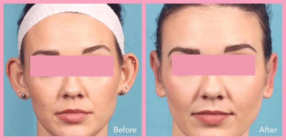 62912a1e596733a01240ab11_ear-surgery-1