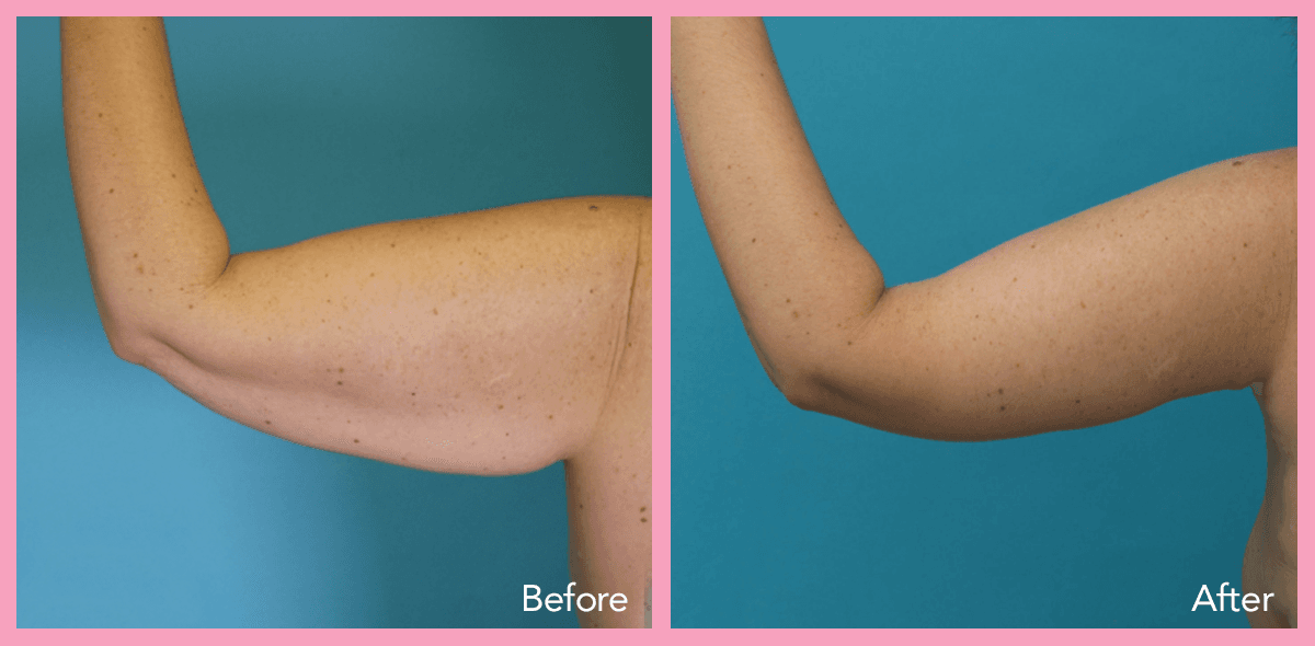 62912a1e596733bbb040ab1b_arm-lift-2