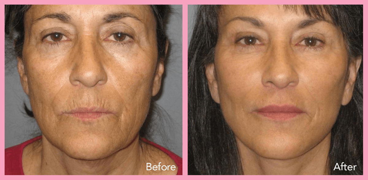 62912a1e596733ce7f40ab18_facelift-3