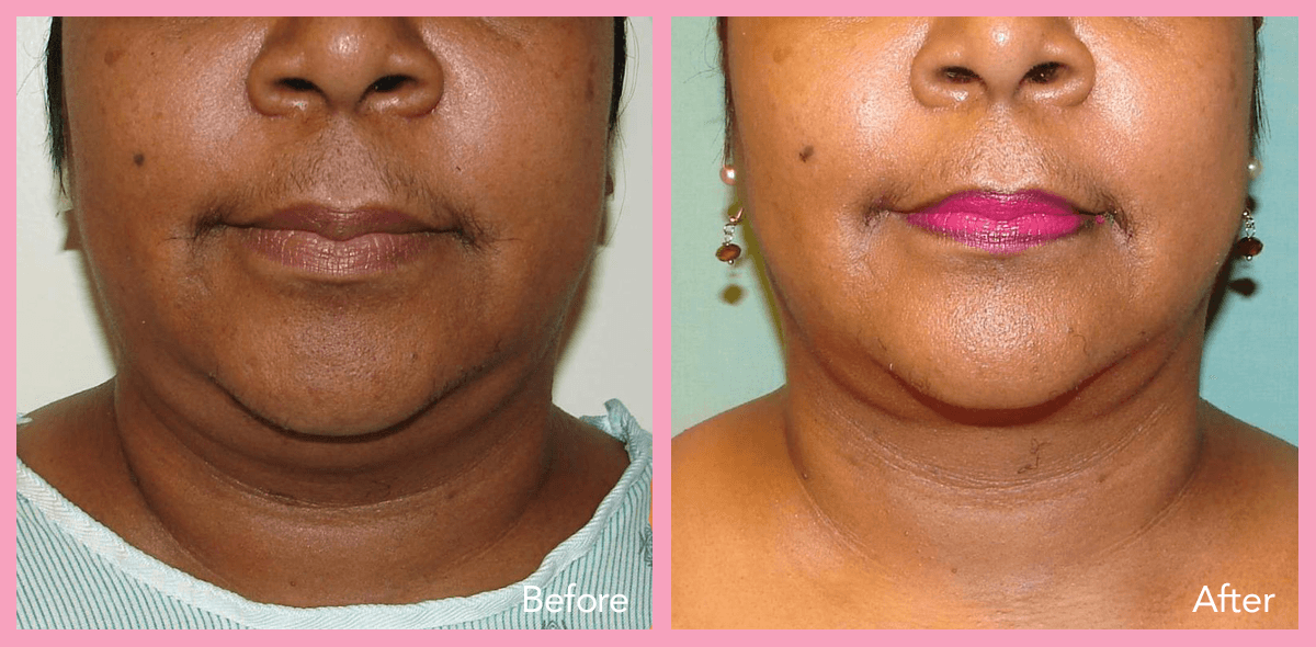 62912a1e596733cff440ab09_neck-lift-2