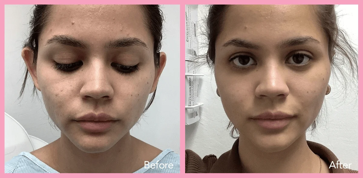 62912a1e596733ebd140ab2e_otoplasty-front