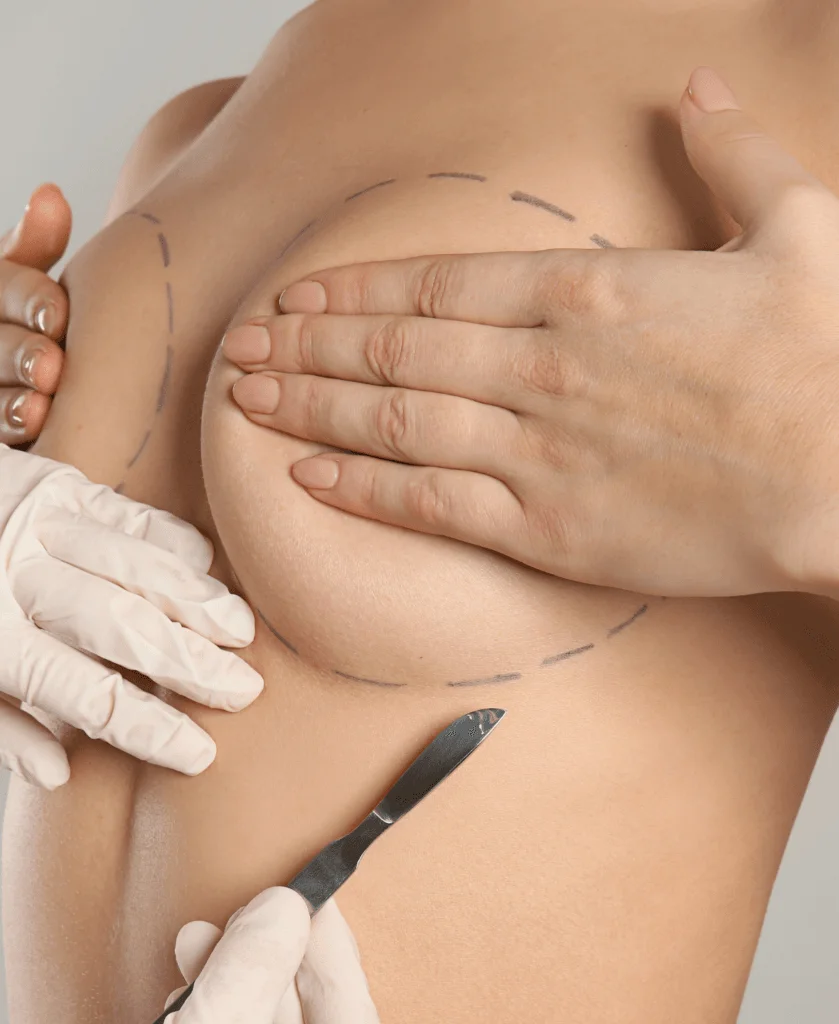 Breast Augmentation Patients at Luxe Allure Cosmetic Surgery
