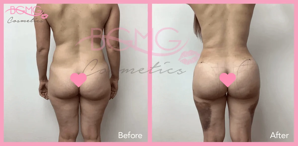Brazilian Butt Lift Treatment - BBL Surgery Before and After Results 04