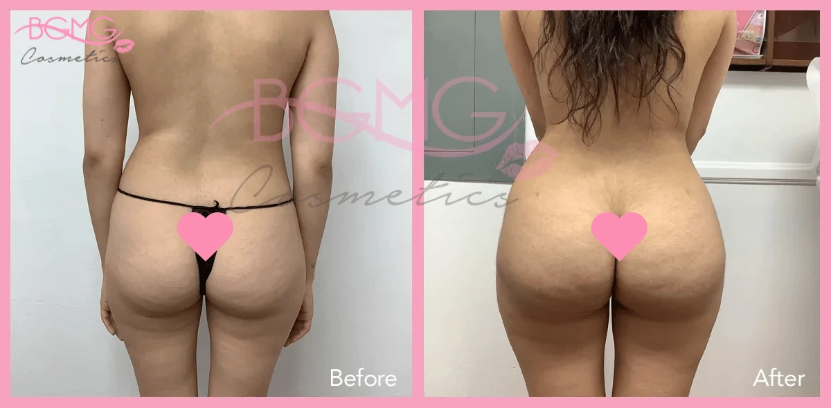 Brazilian Butt Lift Treatment - BBL Surgery Before and After Results 05