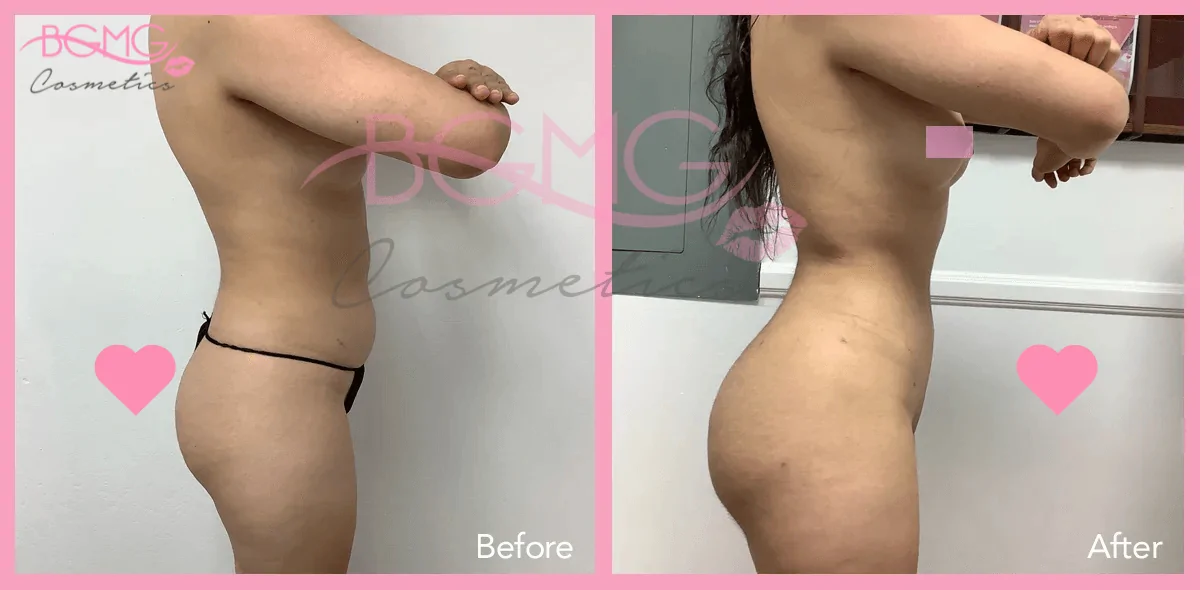 Brazilian Butt Lift Treatment - BBL Surgery Before and After Results 07