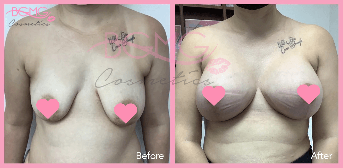 Breast Augmentation Treatment Before and After Results 03