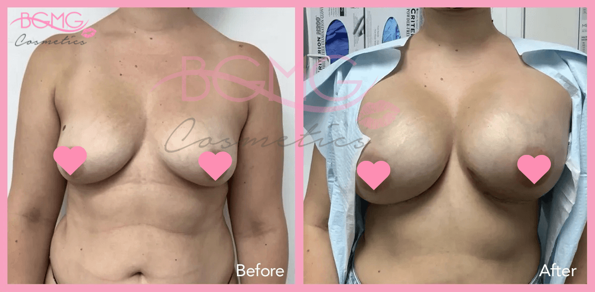 Breast Augmentation Treatment Before and After Results 02