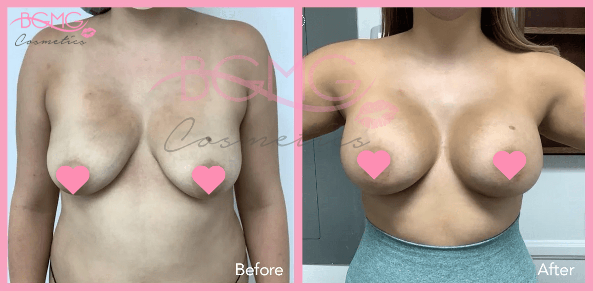 Breast Augmentation Treatment Before and After Results 01