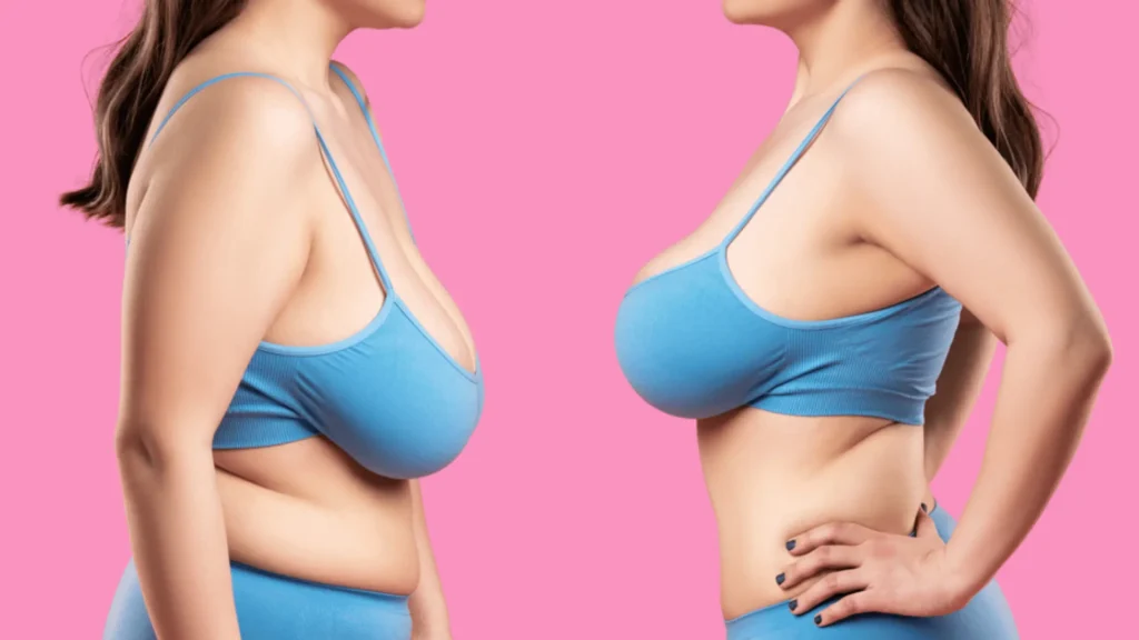 Ideal Candidates for Breast Lift Surgery - Breast lift patient before after comparison