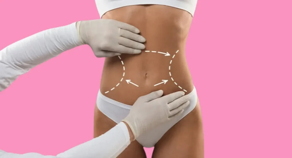 Ideal Candidates for Liposuction Treatment